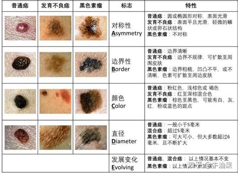 腹部長痣|是痣還是瘤？黑色素瘤的類型、症狀與治療